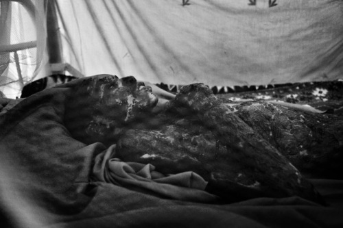 Abakar Tidjani 17 years old lies in bed in Abeche suffering from 3rd degree burns to 80% of his body. He was playing with a grenade when it exploded. Photo by Marcus Bleasdale 